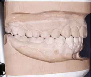 Modelos montados en relación céntrica una vez finalizado el tratamiento con contactos oclusales marcados.