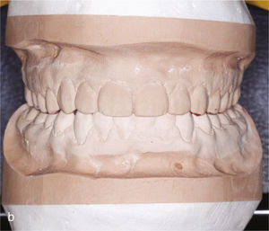 Modelos montados en relación céntrica una vez finalizado el tratamiento con contactos oclusales marcados.