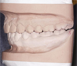 Modelos montados en relación céntrica una vez finalizado el tratamiento con contactos oclusales marcados.