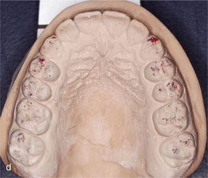Modelos montados en relación céntrica una vez finalizado el tratamiento con contactos oclusales marcados.