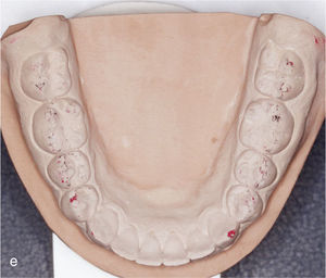 Modelos montados en relación céntrica una vez finalizado el tratamiento con contactos oclusales marcados.