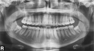 Radiografía panorámica una vez finalizado el tratamiento. Se indicó la extracción de los dientes 38 y 48.