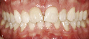 Sector anterosuperior con dientes 11 y 21 en mesioversión y triángulo negro interdental (a). Se colocaron ataches rectangulares verticales en los dientes 11 y 21 y en los anteriores adyacentes. Resultado del tratamiento después de enderezar los dientes 11 y 21 y de cerrar el triángulo negro (b).