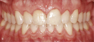 Sector anterosuperior con dientes 11 y 21 en mesioversión y triángulo negro interdental (a). Se colocaron ataches rectangulares verticales en los dientes 11 y 21 y en los anteriores adyacentes. Resultado del tratamiento después de enderezar los dientes 11 y 21 y de cerrar el triángulo negro (b).