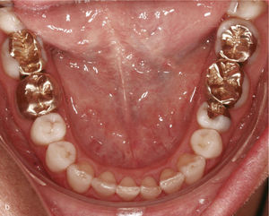 Sector anterosuperior con dientes 11 y 21 en mesioversión y triángulo negro interdental (a). Se colocaron ataches rectangulares verticales en los dientes 11 y 21 y en los anteriores adyacentes. Resultado del tratamiento después de enderezar los dientes 11 y 21 y de cerrar el triángulo negro (b).