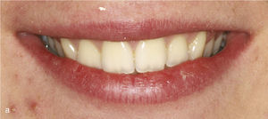 Vista extraoral con corredores vestibulares antes (a) y después (b) de la expansión transversal: disminución de los corredores y mejora de la estética.