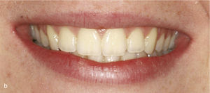 Vista extraoral con corredores vestibulares antes (a) y después (b) de la expansión transversal: disminución de los corredores y mejora de la estética.