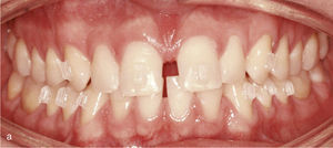 Vista intraoral de los dientes anteriores separados entre sí y de los ataches en los dientes 13, 11, 21 y 23 para el cierre de los espacios y también en los dientes inferiores 33, 34, 35, 43, 44 y 45 para obtener el anclaje necesario para la intrusión de los dientes anteroinferiores (a). Vista intraoral del resultado después del cierre de espacios y de la creación de una sobremordida horizontal y vertical fisiológica (b).