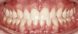 Vista intraoral de los dientes anteriores separados entre sí y de los ataches en los dientes 13, 11, 21 y 23 para el cierre de los espacios y también en los dientes inferiores 33, 34, 35, 43, 44 y 45 para obtener el anclaje necesario para la intrusión de los dientes anteroinferiores (a). Vista intraoral del resultado después del cierre de espacios y de la creación de una sobremordida horizontal y vertical fisiológica (b).