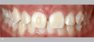 Situación intraoral con curva de Spee marcada y extrusión del sector anterior de ambas arcadas (a). «Direct Bonded Attachments» en los dientes 34, 35, 44 y 45 y en los dientes anterosuperiores para obtener un mayor anclaje. El movimiento a realizar exigía la intrusión por separado de los dientes 32 a 42 y de los dientes 33 y 43. Vista intraoral del resultado final con sobremordida horizontal y vertical fisiológica (b).