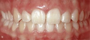 Situación intraoral con curva de Spee marcada y extrusión del sector anterior de ambas arcadas (a). «Direct Bonded Attachments» en los dientes 34, 35, 44 y 45 y en los dientes anterosuperiores para obtener un mayor anclaje. El movimiento a realizar exigía la intrusión por separado de los dientes 32 a 42 y de los dientes 33 y 43. Vista intraoral del resultado final con sobremordida horizontal y vertical fisiológica (b).