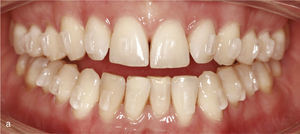 Vista intraoral de la situación con mordida abierta anterior y contactos oclusales únicamente en los dientes 14 a 47 y 27 a 37. Ausencia de guía canina (a). Ataches en los dientes 15 a 25 y 35 a 45 para el movimiento extrusivo. Resultado final con sobremordida horizontal y vertical fisiológicas y guía canina (b).