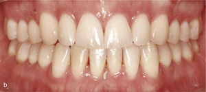 Vista intraoral de la situación con mordida abierta anterior y contactos oclusales únicamente en los dientes 14 a 47 y 27 a 37. Ausencia de guía canina (a). Ataches en los dientes 15 a 25 y 35 a 45 para el movimiento extrusivo. Resultado final con sobremordida horizontal y vertical fisiológicas y guía canina (b).