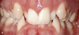Vista intraoral de la situación con los dientes elevados 13 y 23, dientes conoides 12 y 22 y falta de armonía en la línea gingival (a). Situación después del tratamiento con Invisalign: conformación de arcadas armoniosas y nivelación de la altura gingival (b).