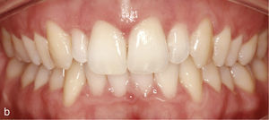 Vista intraoral de la situación con los dientes elevados 13 y 23, dientes conoides 12 y 22 y falta de armonía en la línea gingival (a). Situación después del tratamiento con Invisalign: conformación de arcadas armoniosas y nivelación de la altura gingival (b).