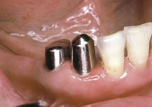 Traumatismo directo y adhesión de placa debido a que el margen de las coronas secundarias está localizado subgingivalmente.