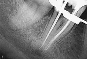 Una curvatura apical marcada y una preparación con escalón distal en el diente 46 impiden una instrumentación completa. Radiografía con contraste para determinar la ubicación exacta del escalón distal (a). Control al cabo de 1 año de la intervención sin signos patológicos apicales. Sospecha de una discrepancia marginal en el mar-gen distal de la corona (b).