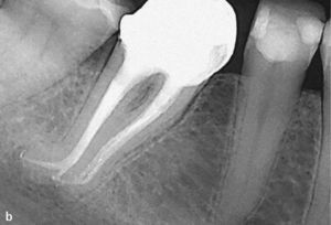 Una curvatura apical marcada y una preparación con escalón distal en el diente 46 impiden una instrumentación completa. Radiografía con contraste para determinar la ubicación exacta del escalón distal (a). Control al cabo de 1 año de la intervención sin signos patológicos apicales. Sospecha de una discrepancia marginal en el mar-gen distal de la corona (b).