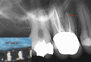 Extracción de un fragmento retenido en el foramen apical. En la imagen se observa, además del fragmento de pequeño tamaño situado en la zona periapical (flecha), una imagen radiolúcida apical sugestiva de una colonización bacteriana intraconducto persistente (a). Se logró la extracción completa del fragmento sin extrusión periapical (b).
