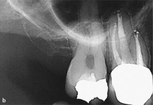 Extracción de un fragmento retenido en el foramen apical. En la imagen se observa, además del fragmento de pequeño tamaño situado en la zona periapical (flecha), una imagen radiolúcida apical sugestiva de una colonización bacteriana intraconducto persistente (a). Se logró la extracción completa del fragmento sin extrusión periapical (b).