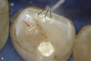 Se pasó por alto la puerta de entrada de una infección en un diente 12 sin caries a través de una invaginación. Vista desde palatino con displasias del esmalte en incisal y un agu-jero ciego con apertura ca-meral central (a). Radiografía con contraste del diente 12 para determinar la trayecto-ria de los conductos radicu-lares. Se desvitalizó el diente 11 en otro centro (b).
