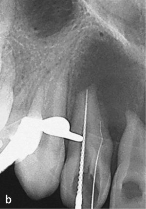 Se pasó por alto la puerta de entrada de una infección en un diente 12 sin caries a través de una invaginación. Vista desde palatino con displasias del esmalte en incisal y un agu-jero ciego con apertura ca-meral central (a). Radiografía con contraste del diente 12 para determinar la trayecto-ria de los conductos radicu-lares. Se desvitalizó el diente 11 en otro centro (b).