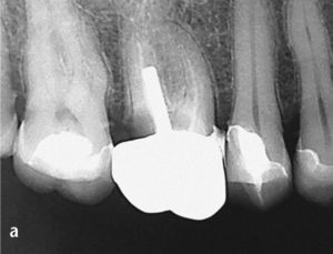 Radiografía inicial del diente 16 obtenida para deter-minar las perspectivas de conser-vación. No se visualiza bien la tra-yectoria del conducto radicular. Una infraobturación y una lesión de caries profunda distal sugieren que la inversión para conservar el diente será cuantiosa (a). Una vez finalizado el tratamiento endodóntico hará falta un alargamiento coronario quirúrgico o una extrusión ortodóncica para poder realizar una restauración con corona adecuada (b).