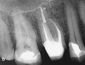 Radiografía inicial del diente 16 obtenida para deter-minar las perspectivas de conser-vación. No se visualiza bien la tra-yectoria del conducto radicular. Una infraobturación y una lesión de caries profunda distal sugieren que la inversión para conservar el diente será cuantiosa (a). Una vez finalizado el tratamiento endodóntico hará falta un alargamiento coronario quirúrgico o una extrusión ortodóncica para poder realizar una restauración con corona adecuada (b).