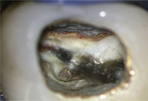 Evaluación de la situación después de la aper-tura cameral. Una vez preparada la cavidad de acceso endodóntico en el diente 27 se observa intracoronalmen-te una caries secundaria a la altura del margen mesial de la corona. Una vez finalizado el tratamiento endodóntico será imprescindible confeccionar una corona nueva para evitar filtraciones.
