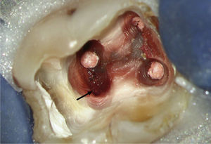 El diente 36 muestra una tinción rojo-pardusca que revela la presencia de una pasta de obturación con resorcinol-formaldehído de difícil eliminación. En distal se observa un conducto radicular no tratado (flecha).