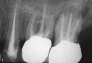 Obturación de una perforación de gran tamaño que comunica con la cavidad oral. Radiografía inicial del diente 26 con una infraobturación, una imagen radiolúcida apical y una imagen radiolúcida en la zona de la trifurca-ción radicular (a). Imagen de la perforación después de la limpieza en el centro de la trifurcación (b). Sellado adhesivo de la perforación con composite (c). La radiografía del diente 26 practicada 2 años después de finalizar el tratamiento endodóntico muestra una regeneración completa de la trifurcación (d).