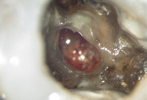 Obturación de una perforación de gran tamaño que comunica con la cavidad oral. Radiografía inicial del diente 26 con una infraobturación, una imagen radiolúcida apical y una imagen radiolúcida en la zona de la trifurca-ción radicular (a). Imagen de la perforación después de la limpieza en el centro de la trifurcación (b). Sellado adhesivo de la perforación con composite (c). La radiografía del diente 26 practicada 2 años después de finalizar el tratamiento endodóntico muestra una regeneración completa de la trifurcación (d).