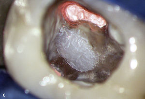 Obturación de una perforación de gran tamaño que comunica con la cavidad oral. Radiografía inicial del diente 26 con una infraobturación, una imagen radiolúcida apical y una imagen radiolúcida en la zona de la trifurca-ción radicular (a). Imagen de la perforación después de la limpieza en el centro de la trifurcación (b). Sellado adhesivo de la perforación con composite (c). La radiografía del diente 26 practicada 2 años después de finalizar el tratamiento endodóntico muestra una regeneración completa de la trifurcación (d).