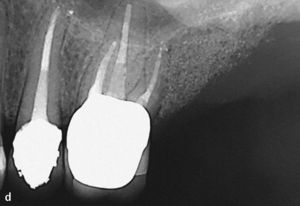 Obturación de una perforación de gran tamaño que comunica con la cavidad oral. Radiografía inicial del diente 26 con una infraobturación, una imagen radiolúcida apical y una imagen radiolúcida en la zona de la trifurca-ción radicular (a). Imagen de la perforación después de la limpieza en el centro de la trifurcación (b). Sellado adhesivo de la perforación con composite (c). La radiografía del diente 26 practicada 2 años después de finalizar el tratamiento endodóntico muestra una regeneración completa de la trifurcación (d).