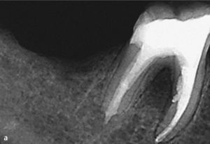 Radiografía de control después de la reparación de una perforación externa inducida por un proceso de reabsorción. La reparación con MTA se encuentra por debajo del límite del hueso alveolar (a). En la radiografía de control practicada 1 año después de la intervención se observa una disminución clara de la imagen radiolúcida en la zona de la bifurcación (b).