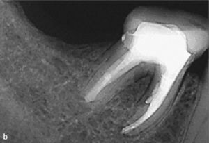 Radiografía de control después de la reparación de una perforación externa inducida por un proceso de reabsorción. La reparación con MTA se encuentra por debajo del límite del hueso alveolar (a). En la radiografía de control practicada 1 año después de la intervención se observa una disminución clara de la imagen radiolúcida en la zona de la bifurcación (b).