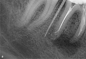 Radiografía mesioexcéntrica del diente 46 con un diagnóstico de vía falsa y una preparación con escalón. Se observan desviaciones de la trayectoria original del conducto radicular tanto en mesial como en distal. Se utilizó una punta de gutapercha para visualizar el trayecto fistuloso en relación con la imagen radiolúcida apical (a). Después de la corrección manual y de la conformación mecanizada del sistema de conductos radiculares se pudo evitar una perforación lateral. Al cabo de 1 año la radiolucidez apical había desaparecido (b).