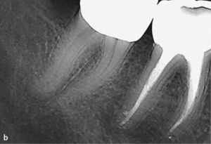 Radiografía mesioexcéntrica del diente 46 con un diagnóstico de vía falsa y una preparación con escalón. Se observan desviaciones de la trayectoria original del conducto radicular tanto en mesial como en distal. Se utilizó una punta de gutapercha para visualizar el trayecto fistuloso en relación con la imagen radiolúcida apical (a). Después de la corrección manual y de la conformación mecanizada del sistema de conductos radiculares se pudo evitar una perforación lateral. Al cabo de 1 año la radiolucidez apical había desaparecido (b).