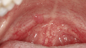 Papiloma de células esca-mosas, confirmado histológicamente, en el paladar blando de un paciente de 31 años.