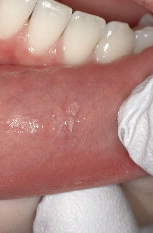 Además de las lesiones anterio-res en el labio superior existe también una do-ble verruga vulgar en el lado izquierdo del labio inferior.