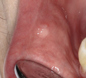Cistoadenoma de una glándula salival menor en la zona vestibular, región del 43, en una pa-ciente de 59 años.