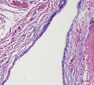 Corte histopatológico de una muestra de tejido obtenida me-diante biopsia (tinción de HE, 20 au-mentos): lesión quística bien delimi-tada revestida por epitelio cúbico y con signos de metaplasia apocrina. El quiste está rodeado por una cáp-sula de tejido conectivo con vasos sanguíneos ectásicos.