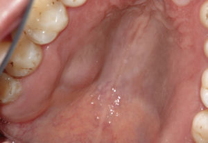 Adenoma pleomórfico (diámetro: 12×14mm) en el paladar duro, región del 16, en un paciente de 46 años de edad.