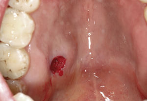 Para el estudio diagnóstico se efectuó una punción-biopsia con anestesia local para la obtención de una muestra de tejido de la zona marginal de la lesión.