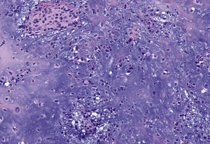 Corte de la muestra (tinción de HE, 20 aumen-tos): tumor de aspecto condroide con islotes epiteliales, células fusiformes y condrocitos.