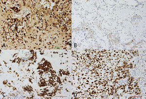 Examen inmunohistoquímico para la tipifica-ción exacta de la lesión: A=proteína S100; condrocitos y células fusiformes (células mioepiteliales) con expre-sión de la proteína S100. B=antígeno Ki-67 (marcador de proliferación); la fracción de proliferación es baja y es inferior al 1%. C=citoqueratina de peso molecular alto (high molecular weight cytokeratin/CKHMW), las células epiteliales expresan citoqueratinas. D=proteína ácida fibrilar glial (glial fibrillary acidic protein/GFAP) (filamen-to intermediario en el citoplasma de las células gliales), acumulación densa de células mioepiteliales con expre-sión de la proteína ácida fibrilar glial.
