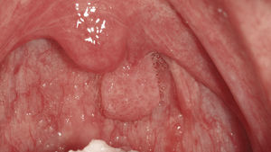 Papiloma de células esca-mosas, confirmado histológicamente, en la úvula de un paciente de 36 años que estaba asintomático en la primera visita.