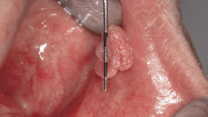 Papiloma de células esca-mosas, confirmado histológicamente, en la mejilla izquierda de un paciente de 56 años.