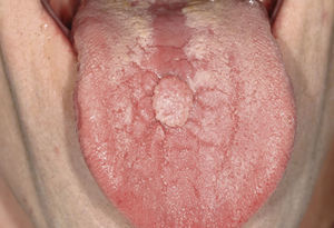 Papiloma de células escamosas en la super-ficie de la lengua en un paciente de 46 años. Desde el punto de vista clínico, el tumor se manifiesta como una proliferación blanquecina, en algunas zonas del mismo color de la mucosa, circunscrita y de base amplia.