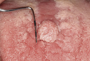 Imagen detallada del tumor de 10×12mm de diámetro.